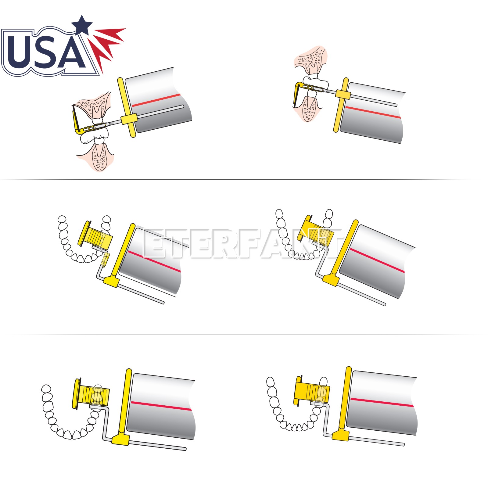 5PCS Dental X-Ray XCP-DS Fit Anterior/Bite wing/Posterior/Endodontic Arm Kit
