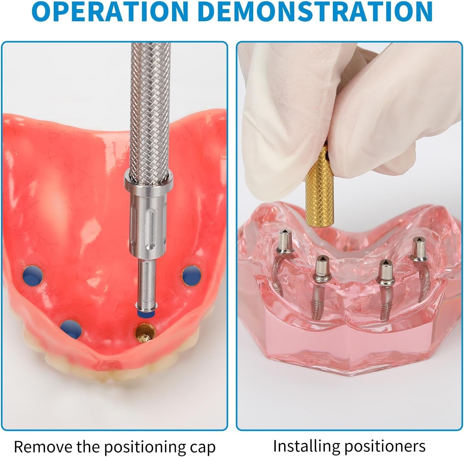 US Dental Zest Locator Retention Caps 0.8/1.2/2.4lbs & Core Tool Kit Overdenture